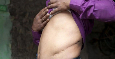 Image of side of a person's torso with their hands lifting their shirt to reveal a large scar